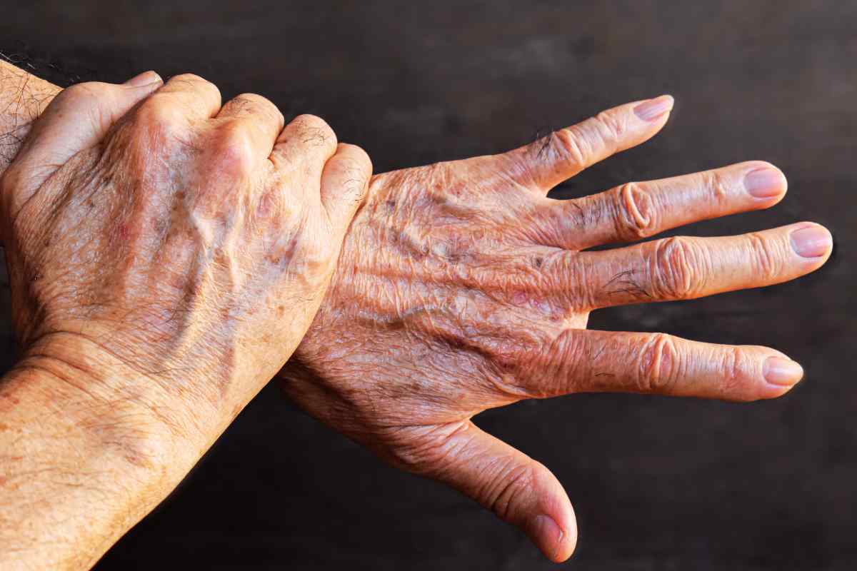 mani con macchie scure